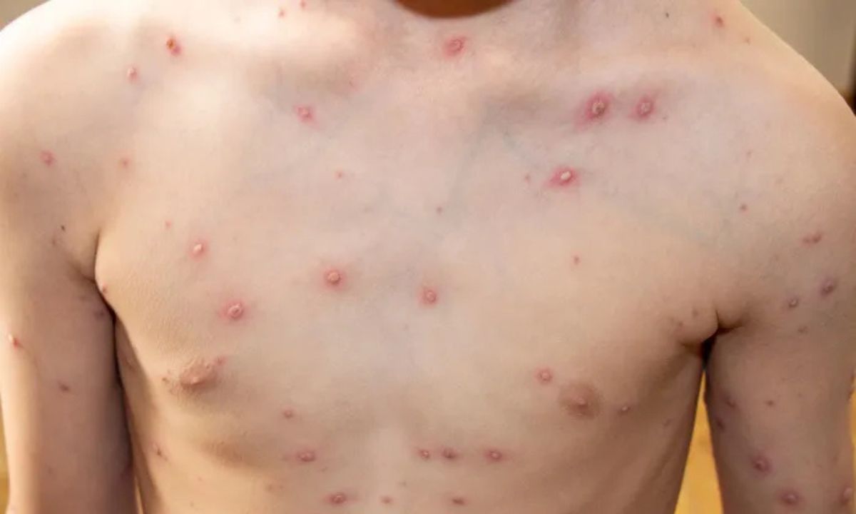Crece el número de casos de varicela en la zona y recomiendan completar la vacunación para evitar complicaciones